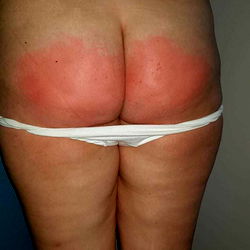 Candid Photography of a Person with Red Marks