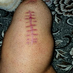 Amp Boy with Knee Injury