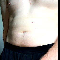 A candid image of OnlyFans model UnderCoverLover showcasing the before and after effects of abdominoplasty surgery.